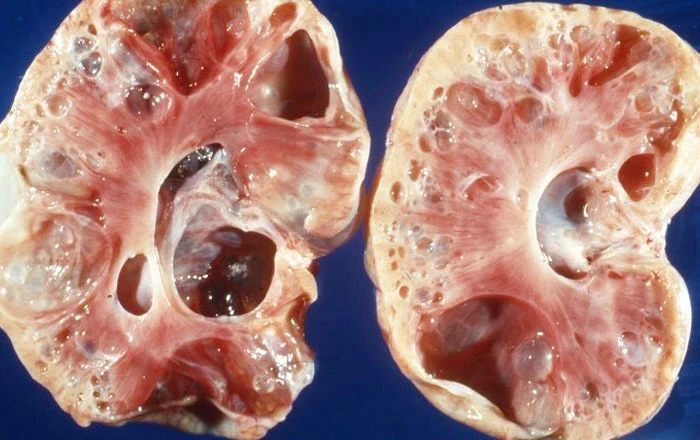 Polycystic Kidney Disease