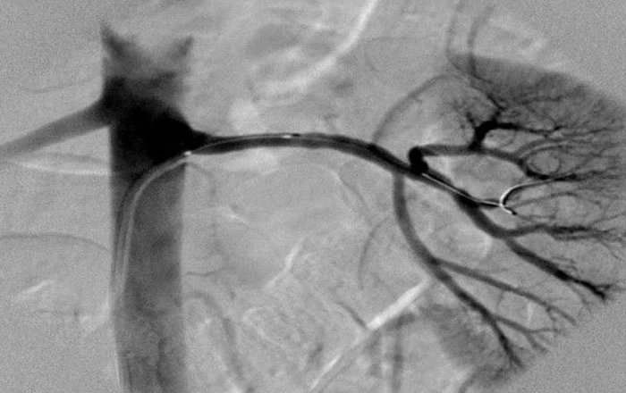 Renal Artery Stenosis