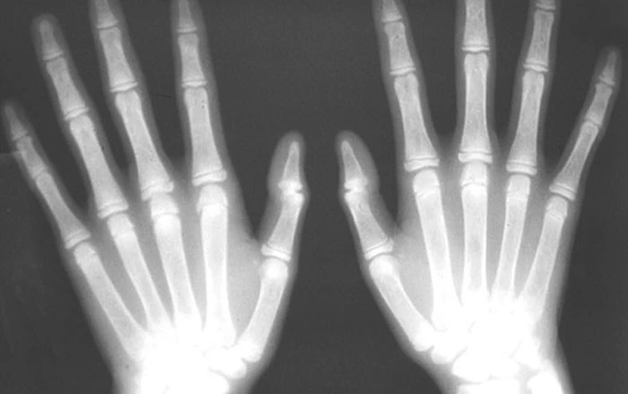 Renal Osteodystrophy