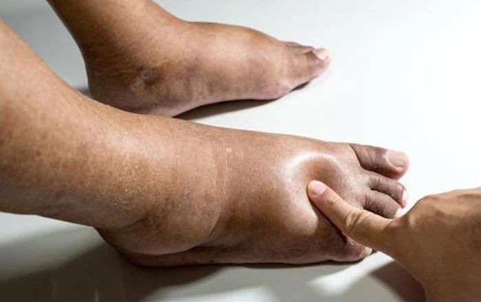 Edema